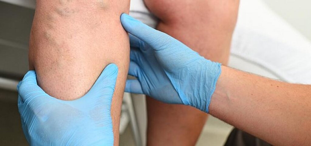 Önlem Alınmadığı Takdirde Varisler Emboliye Neden Olabilir