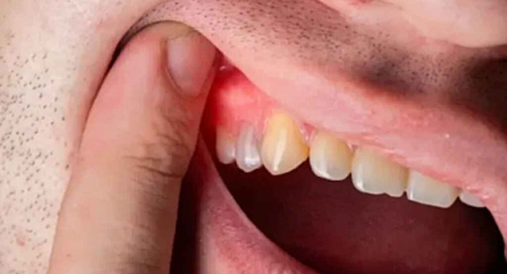 Asidik besinler diş minesini tehdit ediyor