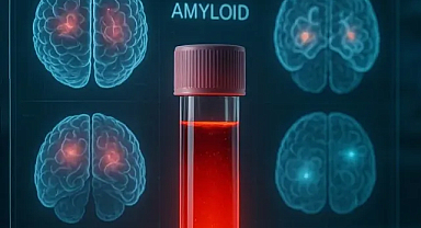 Alzheimer’ı 10 Yıl Önceden Tespit Edebilecek Kan Testi Geliştirildi